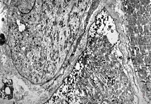 F,66y. | myositis